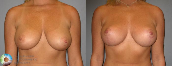 Before & After Breast Lift Case 356 View #1 View in Golden, CO