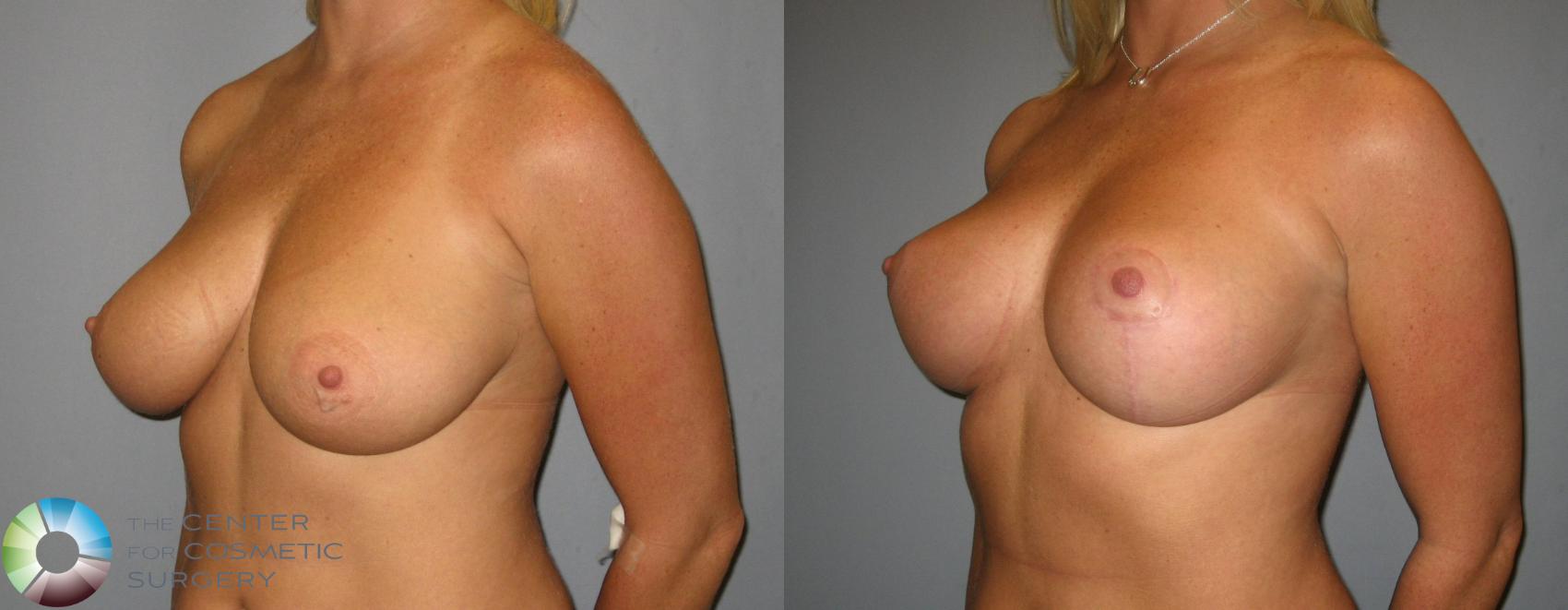 Before & After Breast Lift Case 356 View #2 in Denver and Colorado Springs, CO