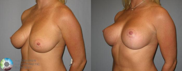 Before & After Breast Lift Case 356 View #2 View in Golden, CO
