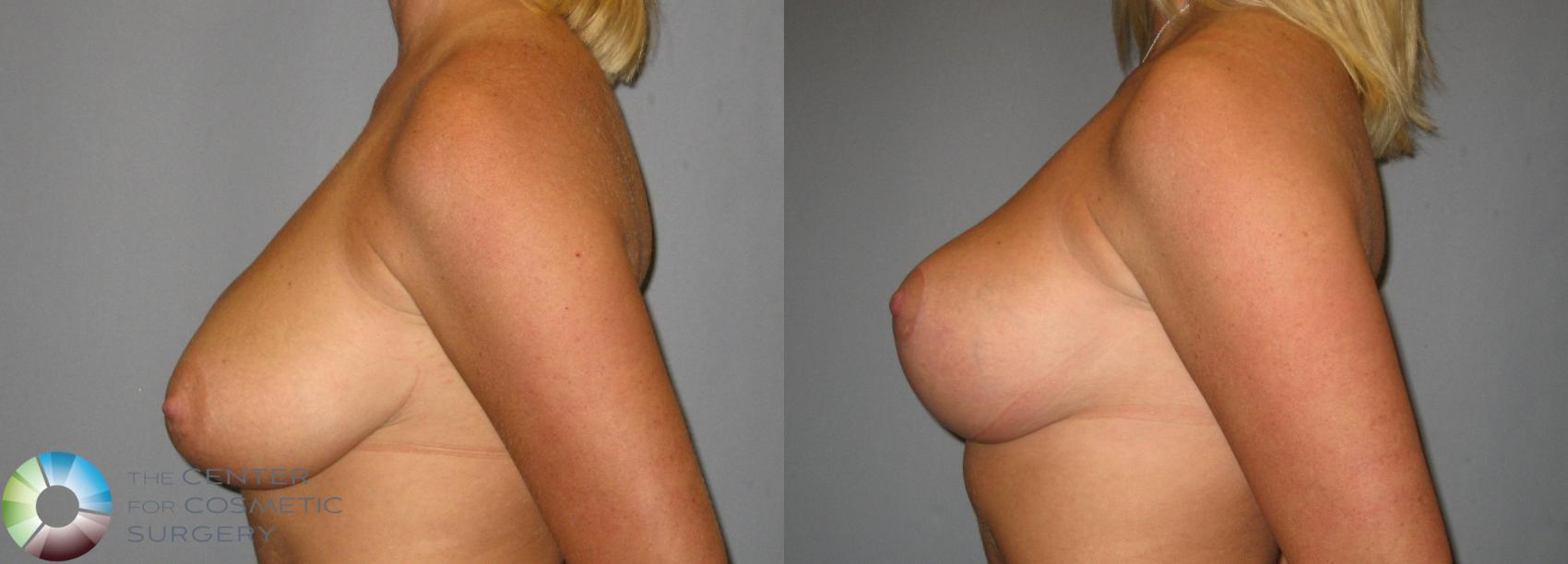 Before & After Breast Lift Case 356 View #3 in Denver and Colorado Springs, CO