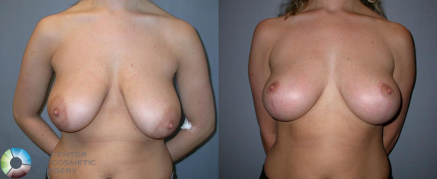 Before & After Breast Lift Case 37 View #1 in Denver and Colorado Springs, CO