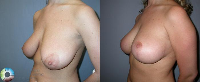 Before & After Breast Lift Case 37 View #2 View in Golden, CO