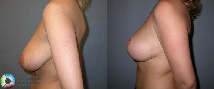 Before & After Breast Lift Case 37 View #3 View in Golden, CO