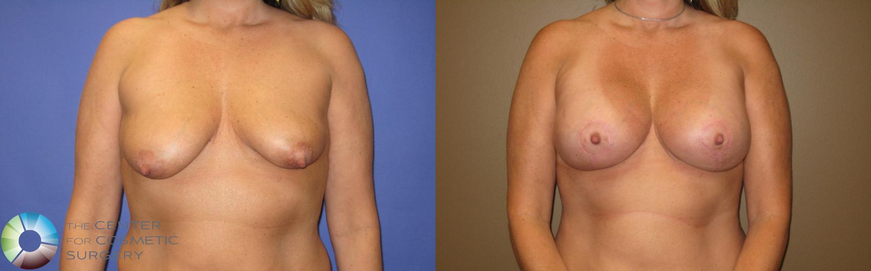 Before & After Breast Lift Case 375 View #1 in Denver and Colorado Springs, CO