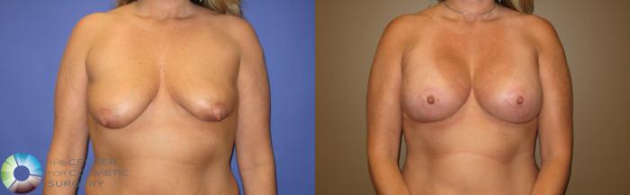 Before & After Breast Lift Case 375 View #1 View in Golden, CO