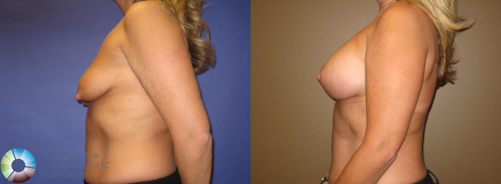 Before & After Breast Lift Case 375 View #2 in Denver and Colorado Springs, CO