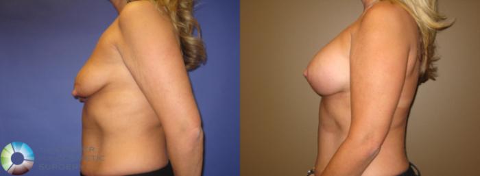 Before & After Breast Lift Case 375 View #2 View in Golden, CO