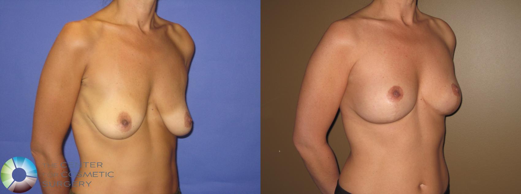 Before & After Breast Lift Case 390 View #2 View in Denver & Golden, CO