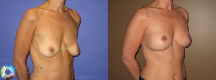 Before & After Breast Lift Case 390 View #2 View in Golden, CO