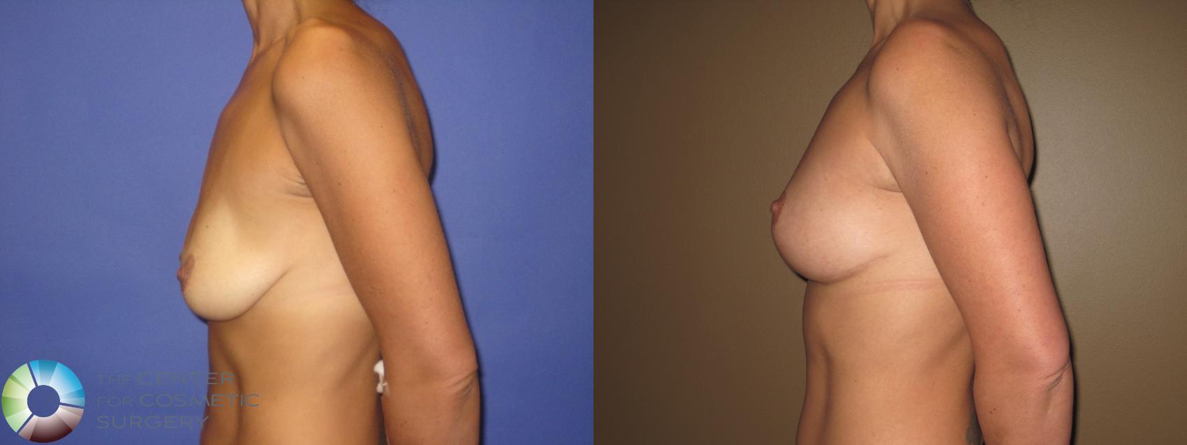 Before & After Breast Lift Case 390 View #3 View in Denver & Golden, CO