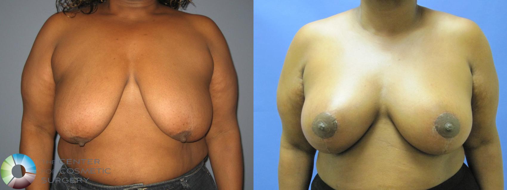 Before & After Breast Augmentation Case 433 View #1 in Denver, CO