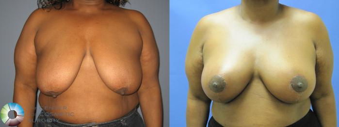 Before & After Breast Lift Case 433 View #1 View in Golden, CO