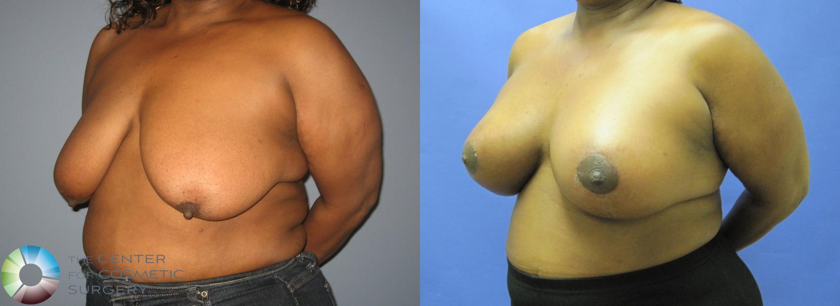 Before & After Breast Lift Case 433 View #2 in Denver and Colorado Springs, CO