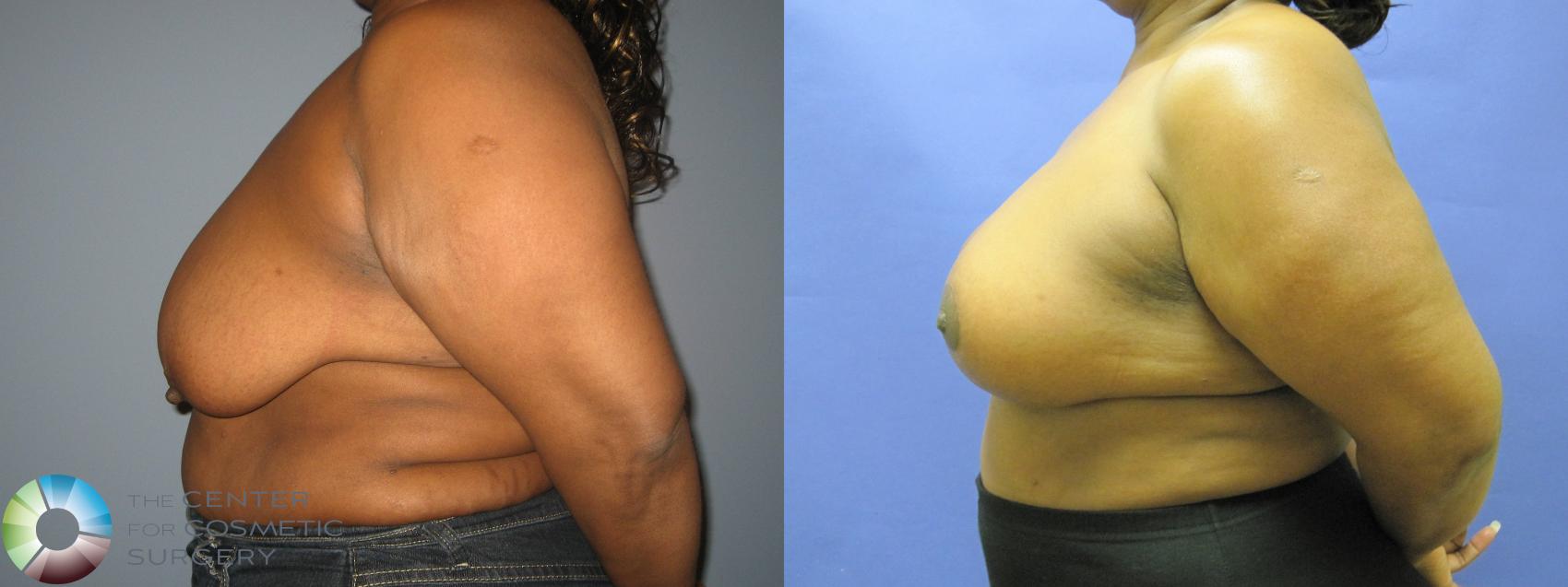 Before & After Breast Lift Case 433 View #3 in Denver and Colorado Springs, CO