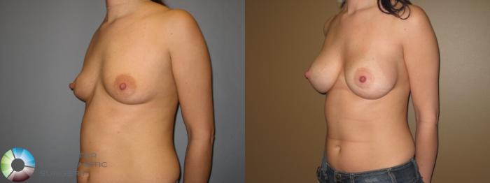 Before & After Breast Augmentation Case 438 View #1 in Denver and Colorado Springs, CO