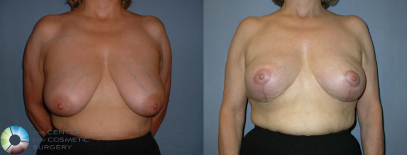 Before & After Breast Lift Case 44 View #1 View in Golden, CO