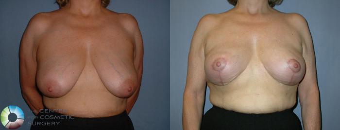 Before & After Breast Lift Case 44 View #1 in Denver and Colorado Springs, CO