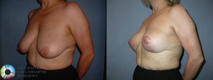 Before & After Breast Lift without Implants Case 44 View #2 in Denver and Colorado Springs, CO