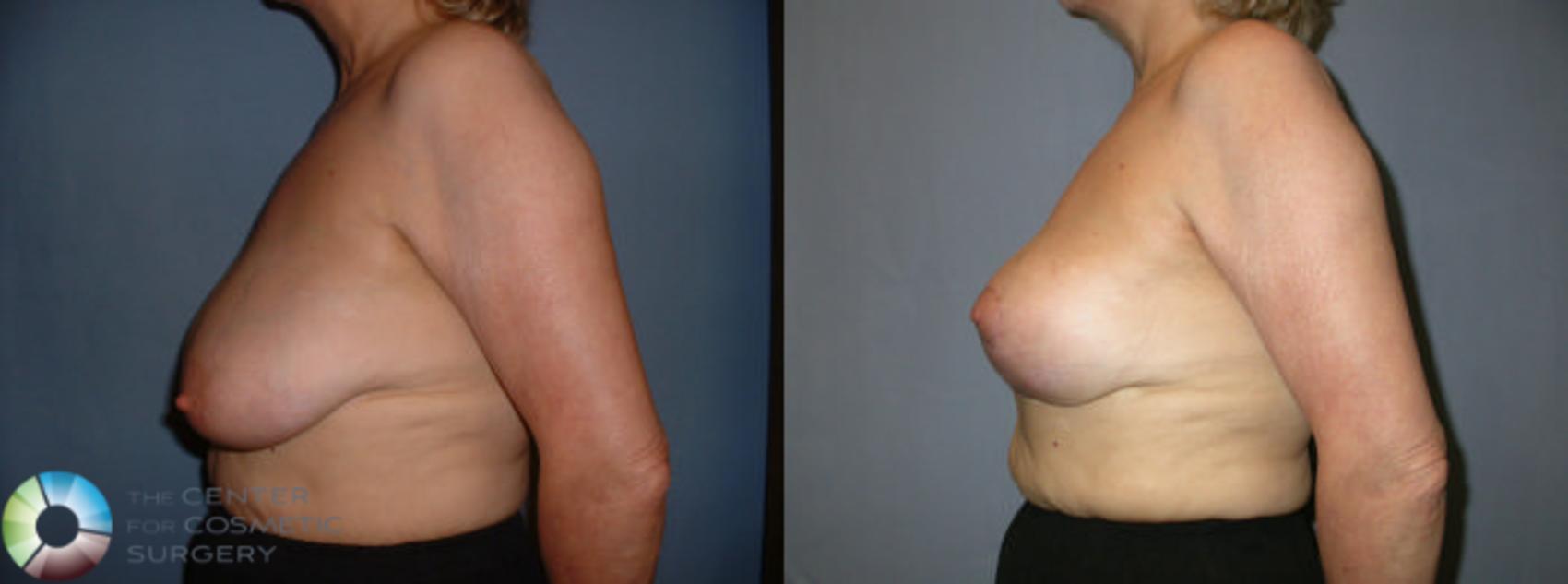 Before & After Breast Lift Case 44 View #3 View in Golden, CO