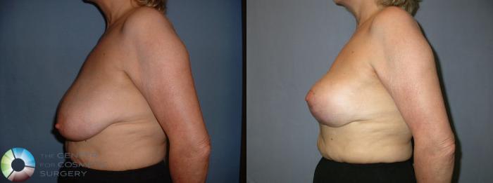 Before & After Breast Lift without Implants Case 44 View #3 in Denver and Colorado Springs, CO