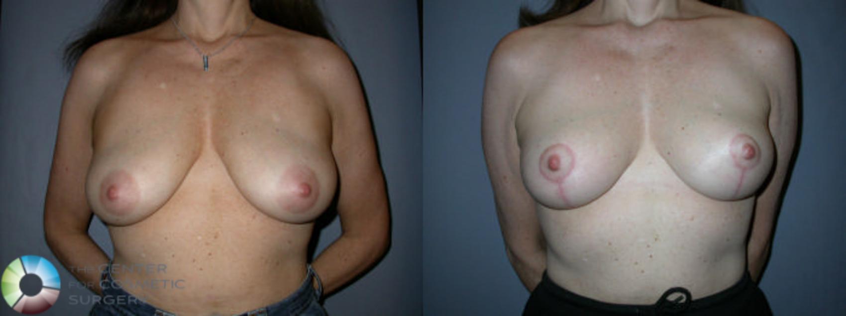 Before & After Breast Lift Case 45 View #1 in Denver, CO