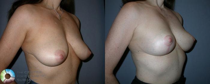 Before & After Breast Lift Case 45 View #2 View in Golden, CO