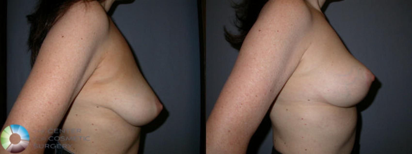Before & After Breast Lift Case 45 View #3 View in Golden, CO