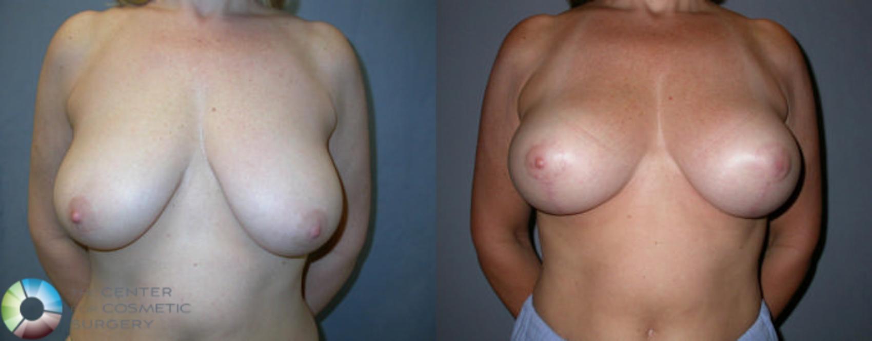 Breast Lift Case 48 Before & After View #1 | Golden, CO | The Center for Cosmetic Surgery