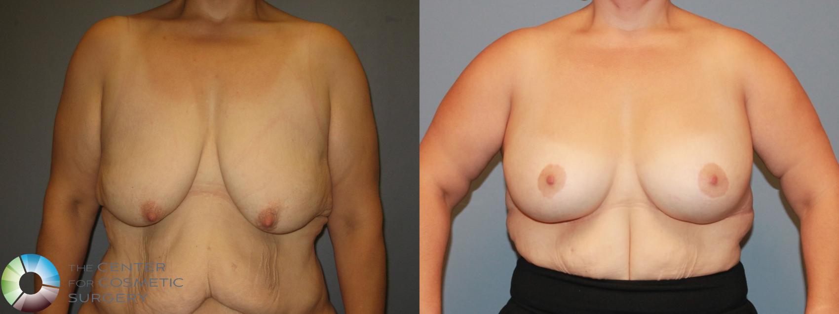 Before & After Breast Augmentation Case 482 View #1 in Denver and Colorado Springs, CO