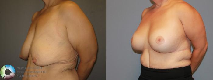 Before & After Breast Lift Case 482 View #2 View in Golden, CO