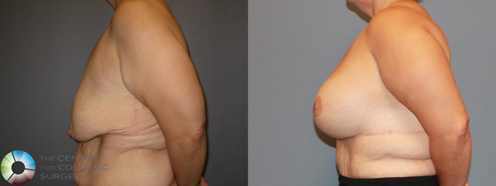 Before & After Breast Lift Case 482 View #3 View in Golden, CO