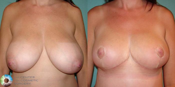 Before & After Breast Lift Case 500 View #1 View in Golden, CO