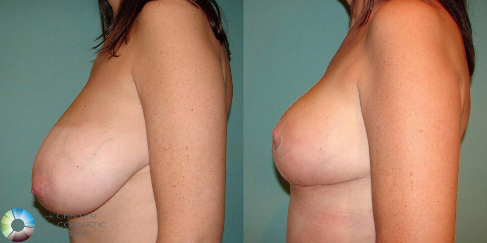 Before & After Breast Lift Case 500 View #2 View in Golden, CO