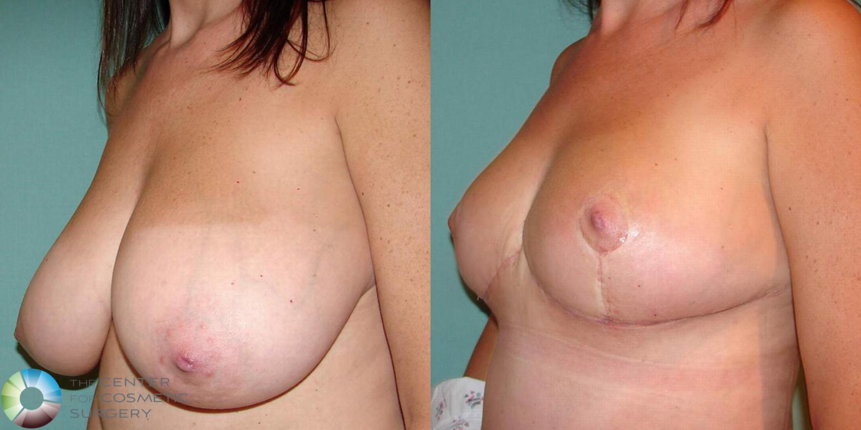 Before & After Breast Lift Case 500 View #3 View in Golden, CO