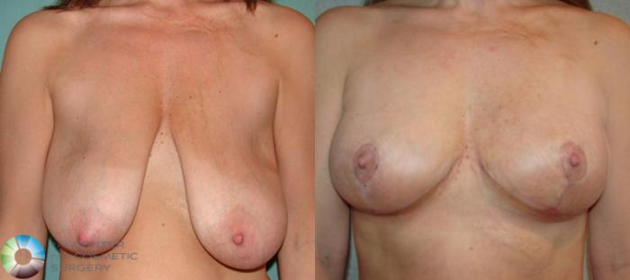Before & After Breast Lift without Implants Case 504 Anterior View in Golden, CO
