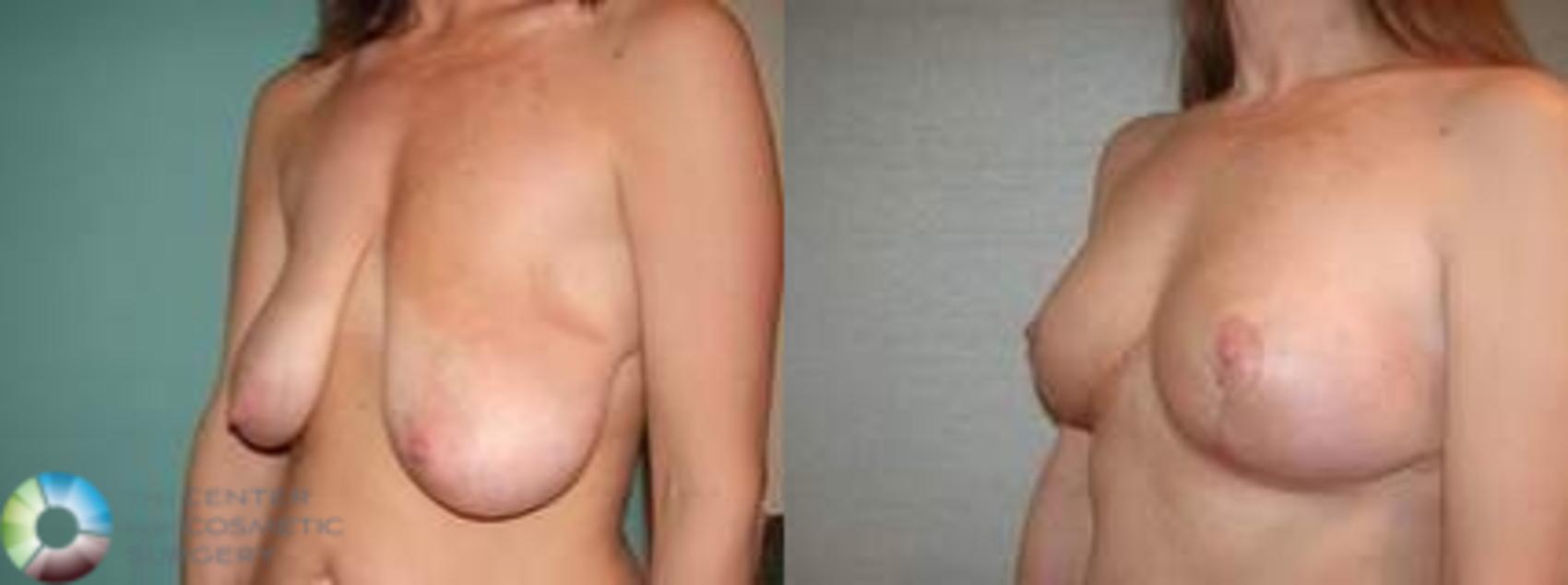 Before & After Breast Lift Case 504 Left Oblique View in Golden, CO