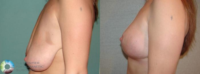 Before & After Breast Lift Case 504 Left Side View in Golden, CO