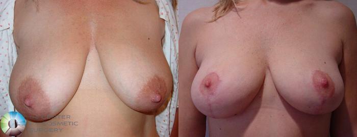 Before & After Breast Lift Case 525 View #1 View in Golden, CO
