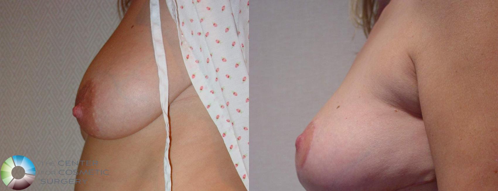 Before & After Breast Lift Case 525 View #2 View in Golden, CO