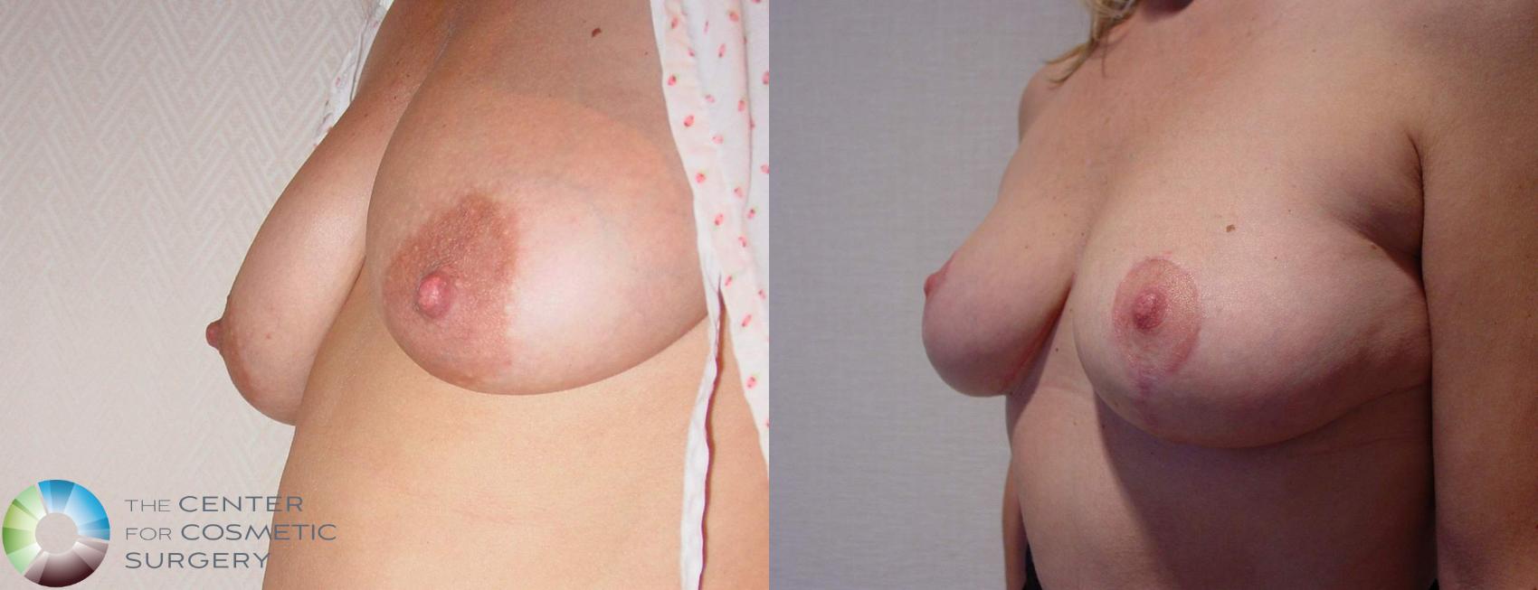 Before & After Breast Lift Case 525 View #3 View in Golden, CO