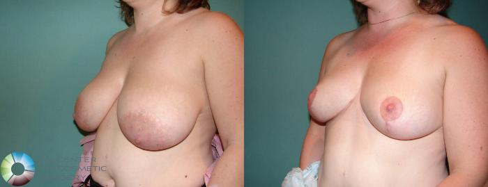 Before & After Breast Lift without Implants Case 534 View #1 in Denver and Colorado Springs, CO