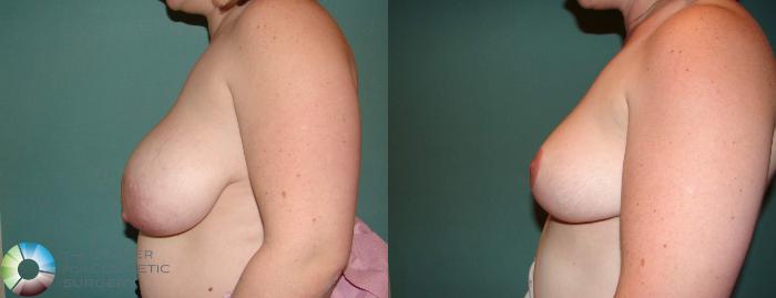 Before & After Breast Lift Case 534 View #2 in Denver and Colorado Springs, CO