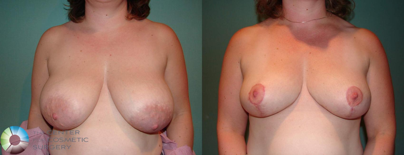 Before & After Breast Lift Case 534 View #3 View in Golden, CO