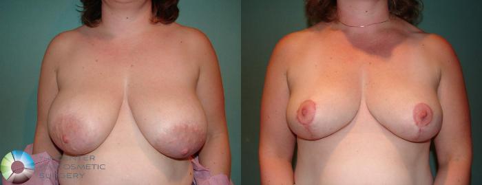 Before & After Breast Lift Case 534 View #3 in Denver and Colorado Springs, CO