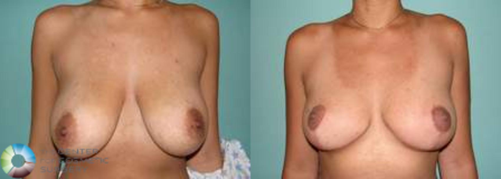 Before & After Breast Lift Case 540 View #1 in Denver and Colorado Springs, CO