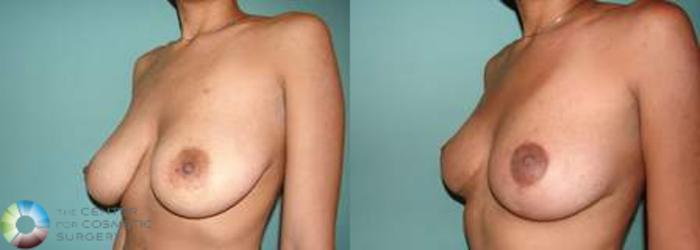 Before & After Breast Lift Case 540 View #2 View in Golden, CO
