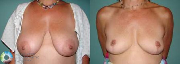 Before & After Breast Lift without Implants Case 541 View #1 in Denver and Colorado Springs, CO