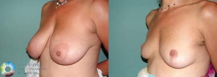 Before & After Breast Lift Case 541 View #2 in Denver and Colorado Springs, CO