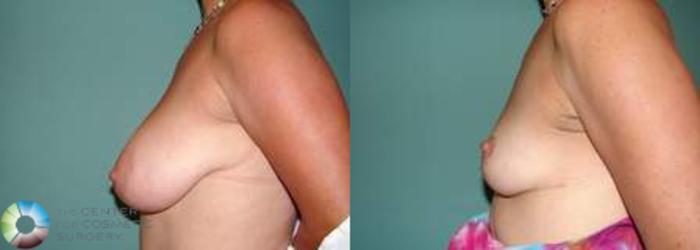 Before & After Breast Lift without Implants Case 541 View #3 in Denver and Colorado Springs, CO