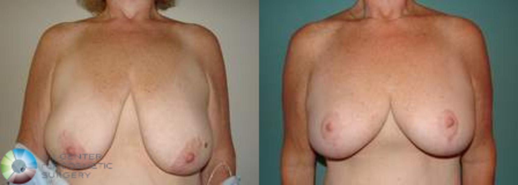 Before & After Breast Lift Case 542 View #1 in Denver and Colorado Springs, CO